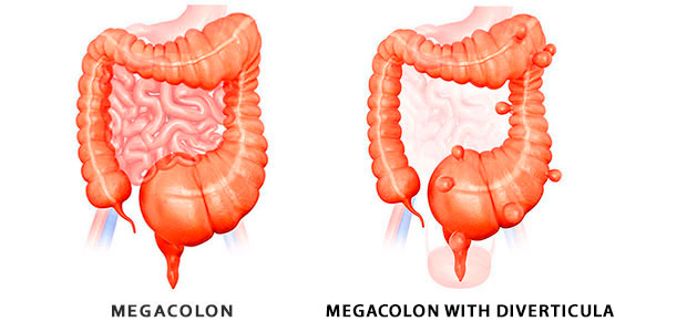 abnormal anatomy of the colon